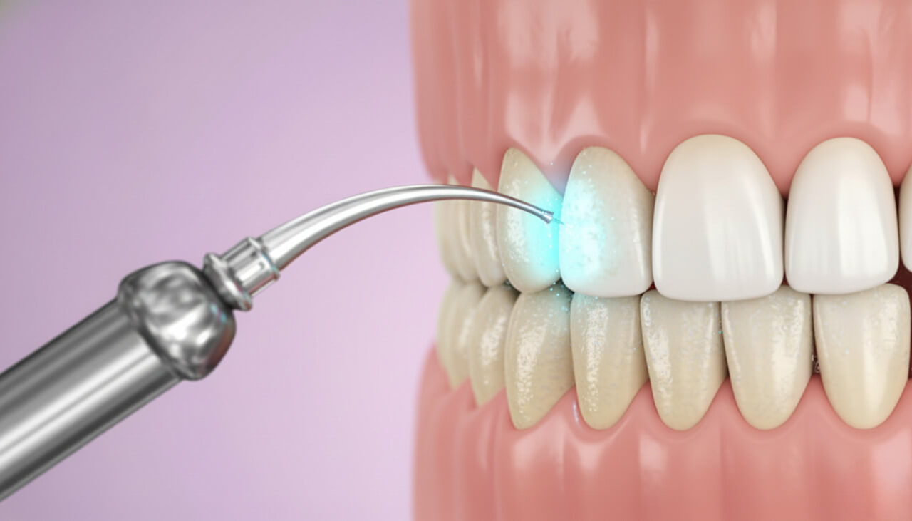 Визуализация процесса ультразвуковой чистки зубов